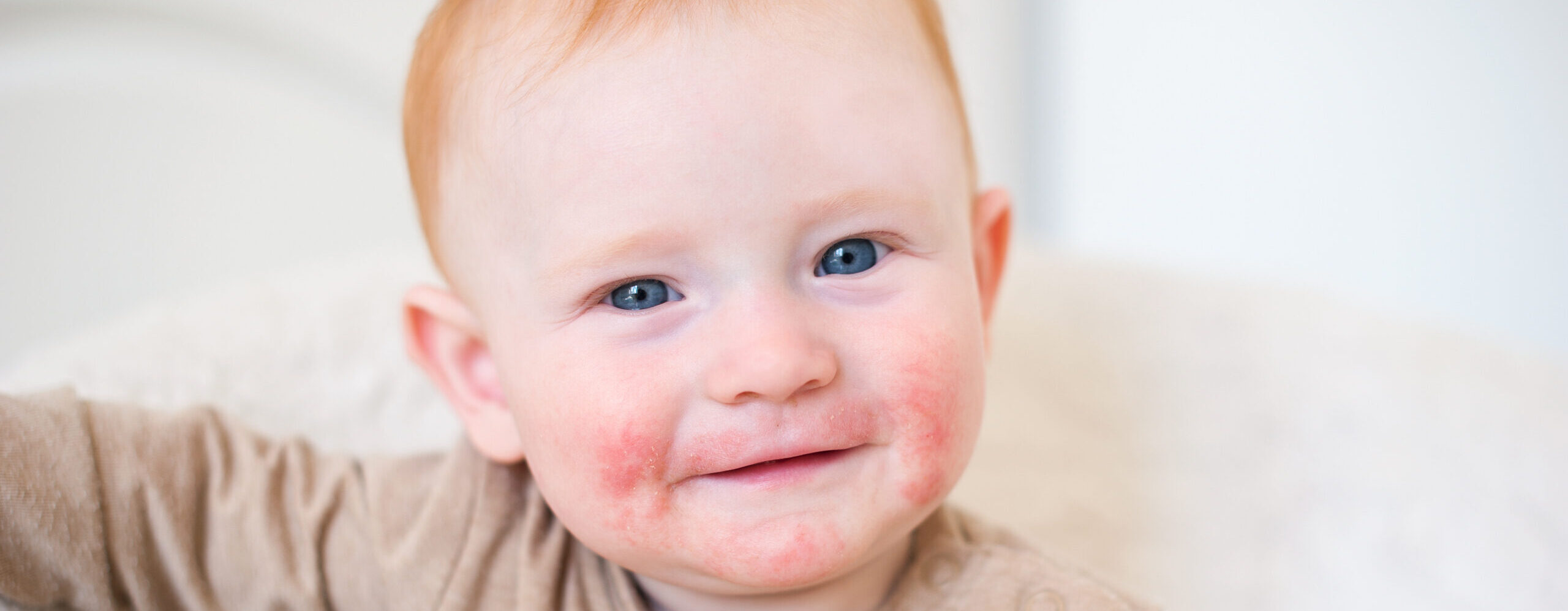 Neurodermitis bei Kindern